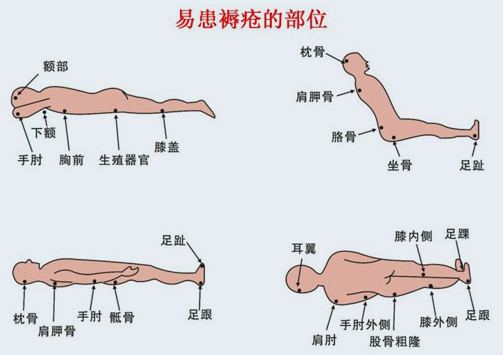 压疮分期图片