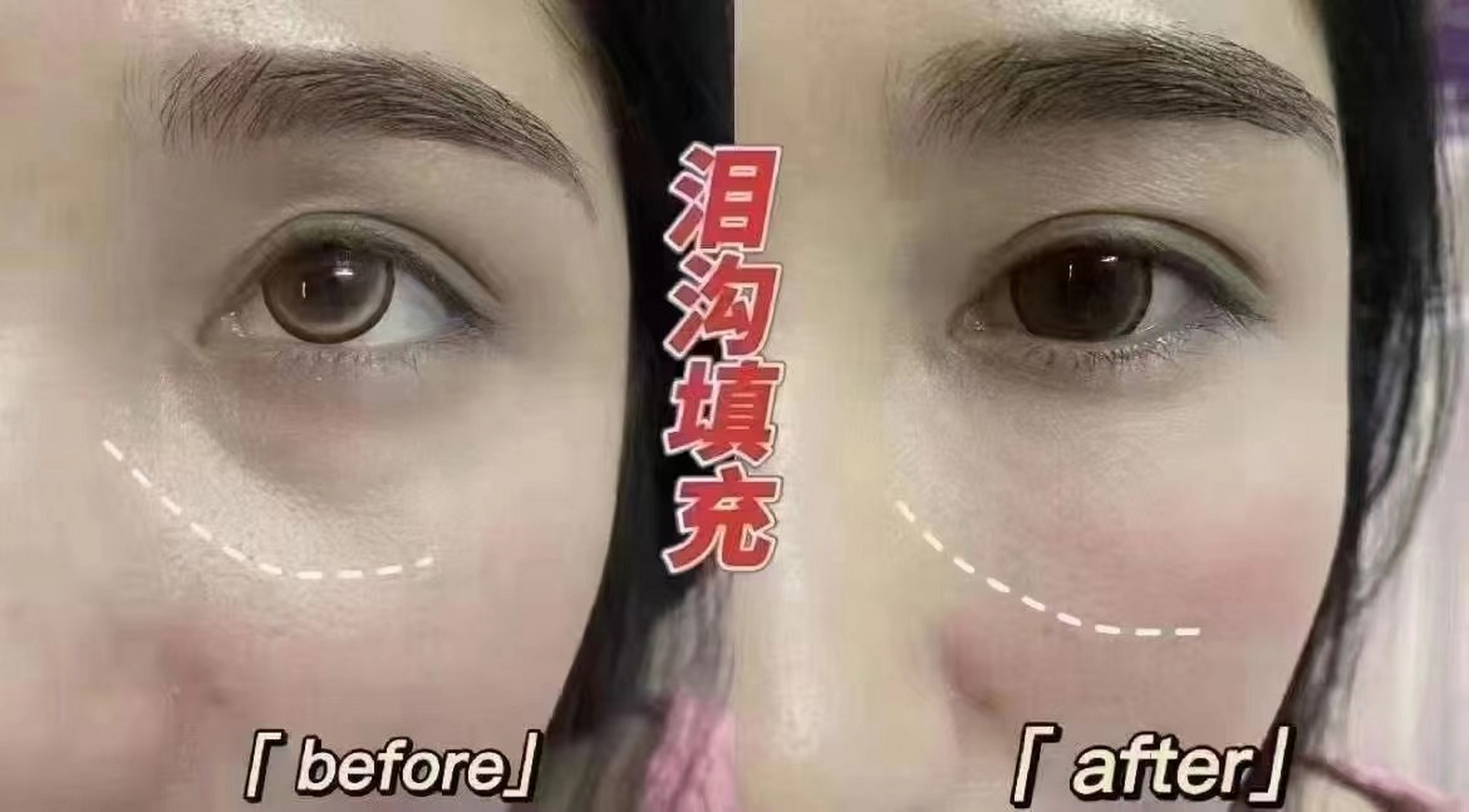 填泪沟用熊猫针还是胶原蛋白好?