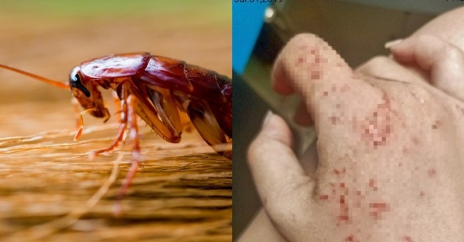 蟑螂咬人有毒吗图片