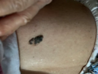 推荐速低头，找痣！知名医生：长在这些地方的都要切除！