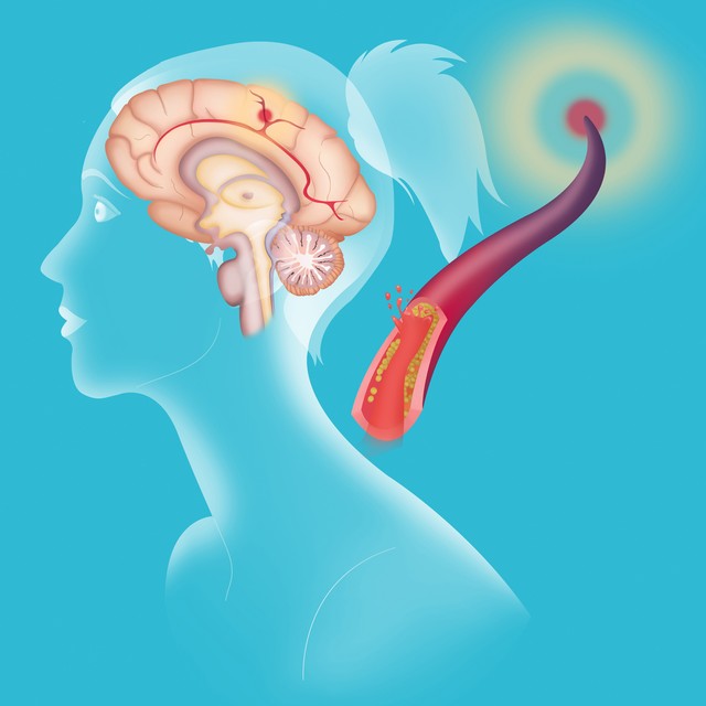 3药活血化瘀,熄风通络,改善脑梗后遗症,保护神经,恢复脑功能