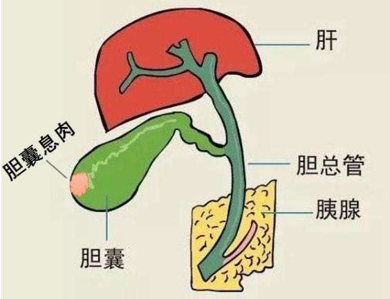 胆囊息肉严重吗图片