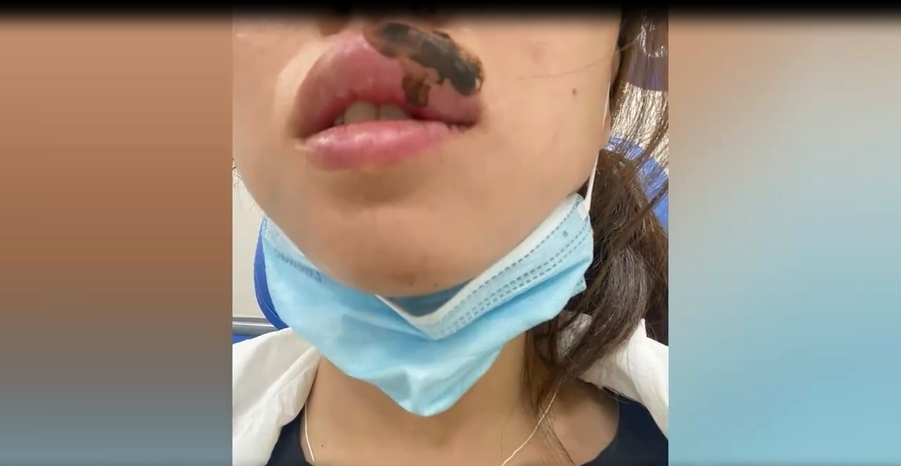 女子睡梦中被蜈蚣咬唇,瞬间肿成"香肠嘴",网友感叹太可怕了
