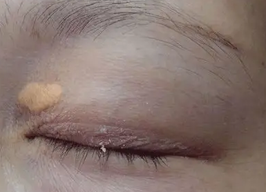 眼皮上的这种东西,你注意了吗?