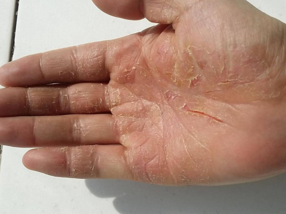 超千万人都在用的祛裂小妙招!低成本但高效,3天搞定手掌干裂!