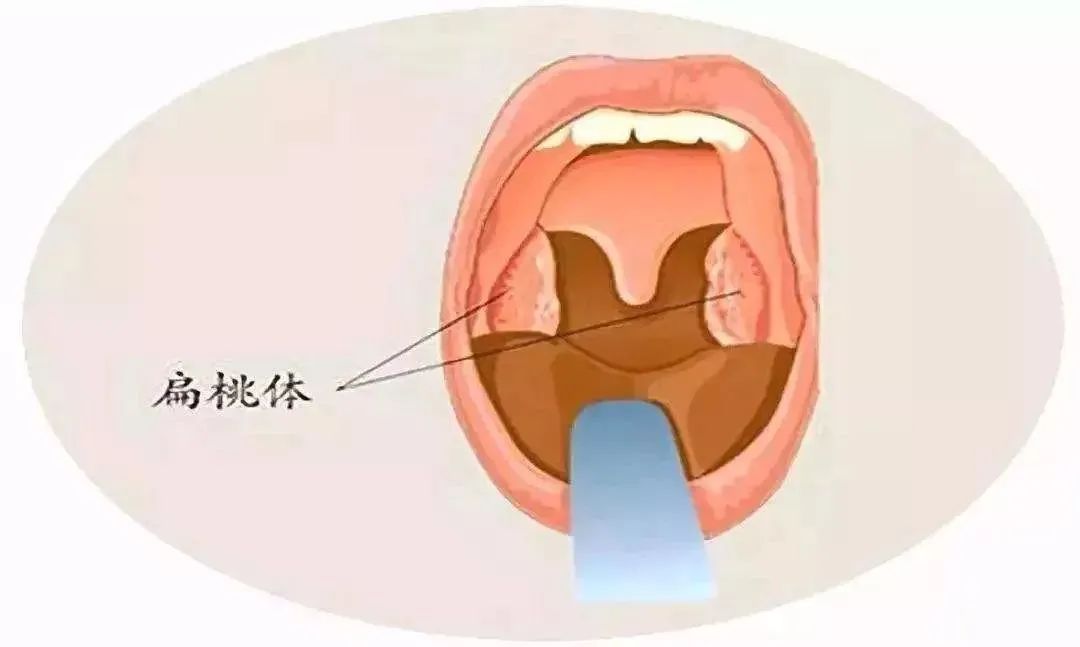 扁桃體炎化膿了怎麼辦 成都民生耳鼻喉醫院治療效果棒 值得信任