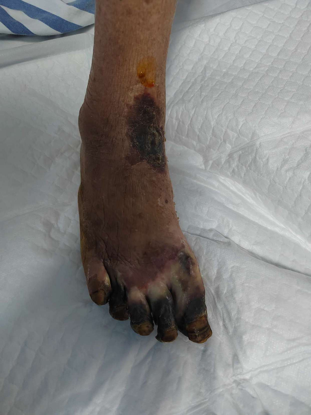 惊呆了!爆血管,肢梗,腿血栓,原来都要这么治疗!