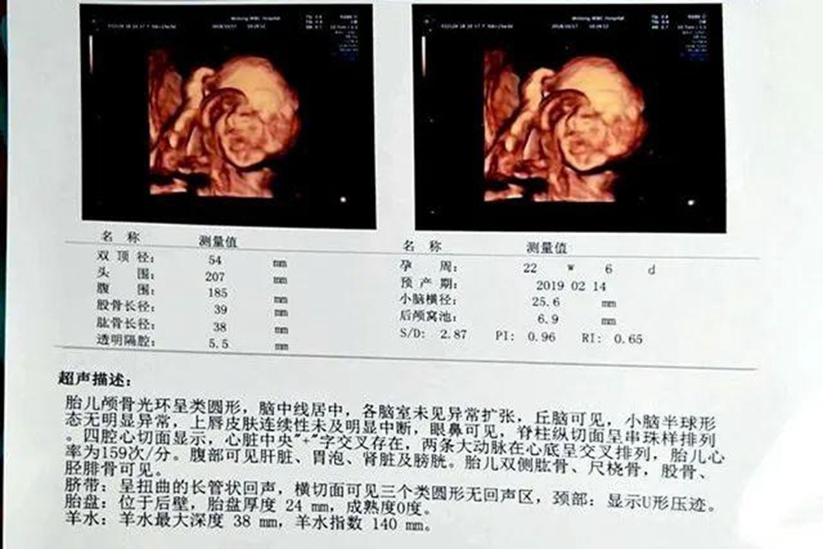 四维彩超正常单子图片图片