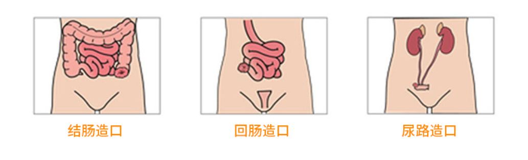 人若没了肛门会怎样?我国"造口人"近150万,怎样解决生存困境
