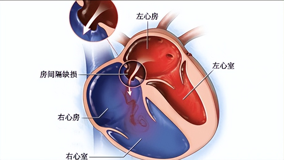 艾森曼格综合征是怎么回事儿?它应该如何治疗?