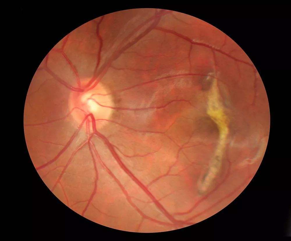 回旋状脉络膜视网膜萎缩,是常染色体隐性遗传病,具有遗传性