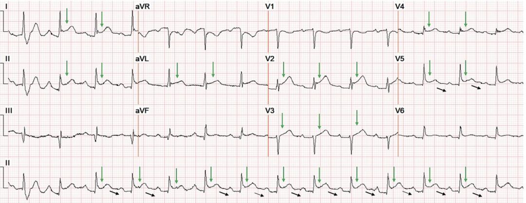 心包炎的心电图图片