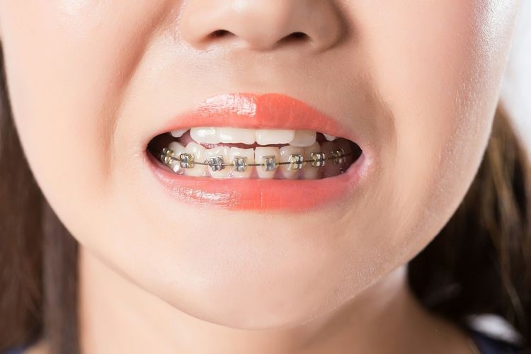 儿童牙齿矫正三个最佳时间:家长别大意,矫治越早效果越好