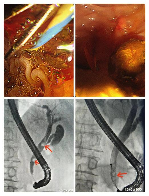 「医诚术精」我院胃肠疾病科首次成功开展2例ercp est联合lc手术
