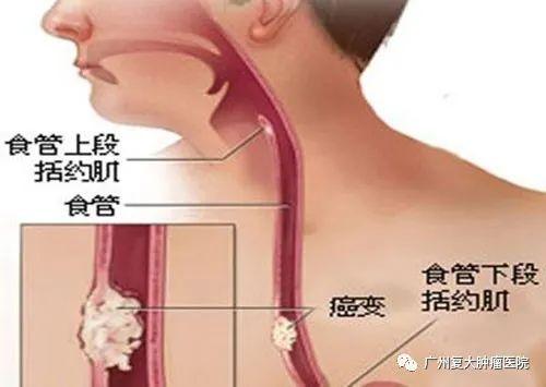 广州复大肿瘤医院案例989:吞咽困难竟然是食管癌在作祟