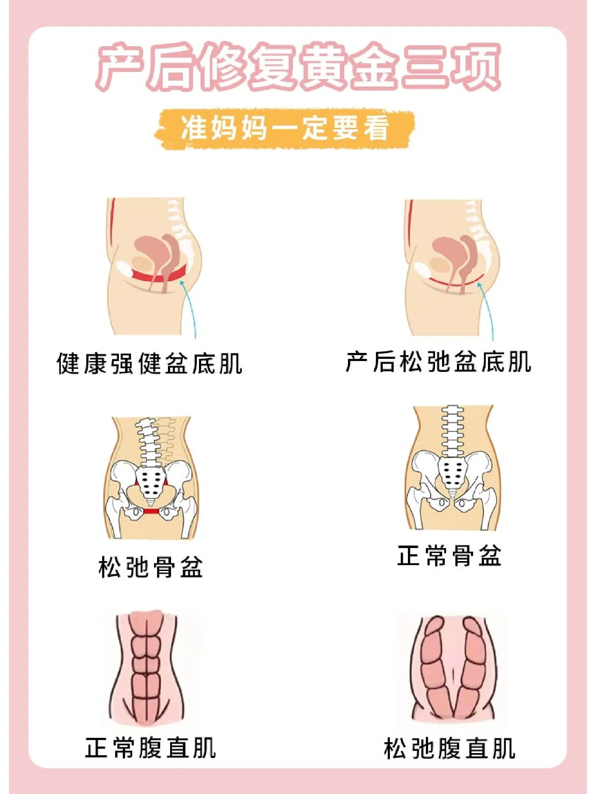 产后修复黄金三项!盆底肌修复!超全干货!