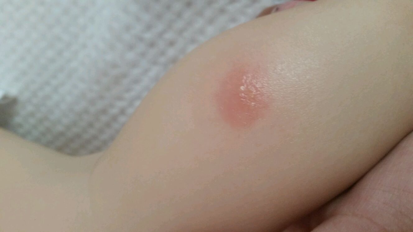 角层下脓疱性皮肤病,症状是脓疱,水泡,红斑,发病部位是皮肤