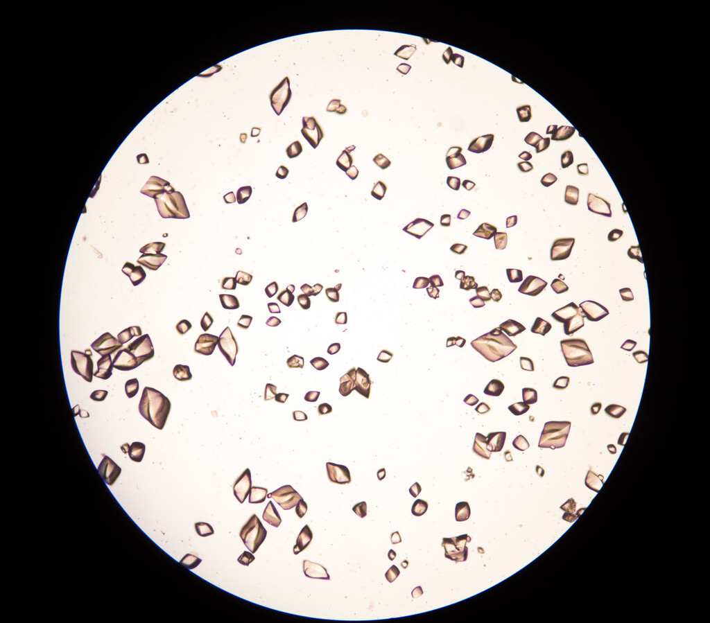 尿酸结晶图片显微镜图片