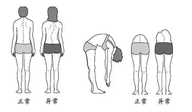 高低肩长短腿正在侵蚀孩子的健康如何预防更重要