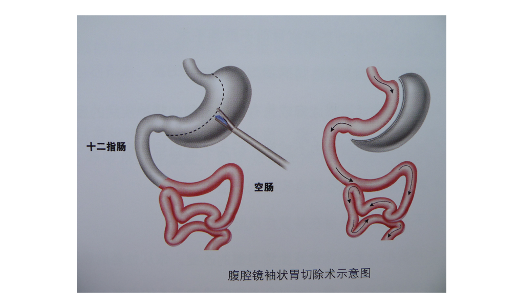 胃手术方式图图片