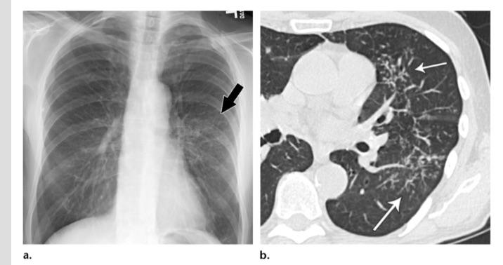 弥漫性支气管炎导致肺容积减小,它的出现使淋巴细胞明显增多