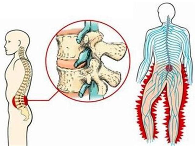 動物不擦屁股不得痔瘡,為啥人類愛乾淨卻會得痔瘡?