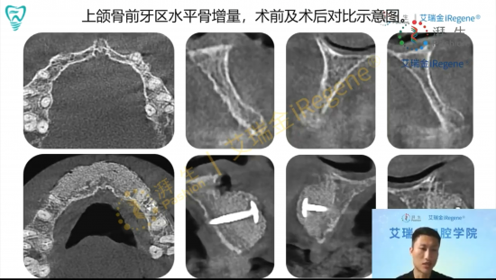 艾瑞金口腔学院-优诺口腔冯楠讲授湃生生物膜应用于水平骨增量