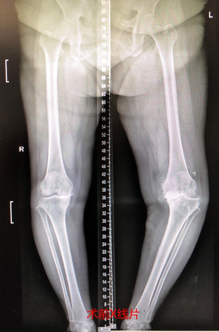 范可尼贫血,可导致多种临床表现,目前预后较差,需早日治疗