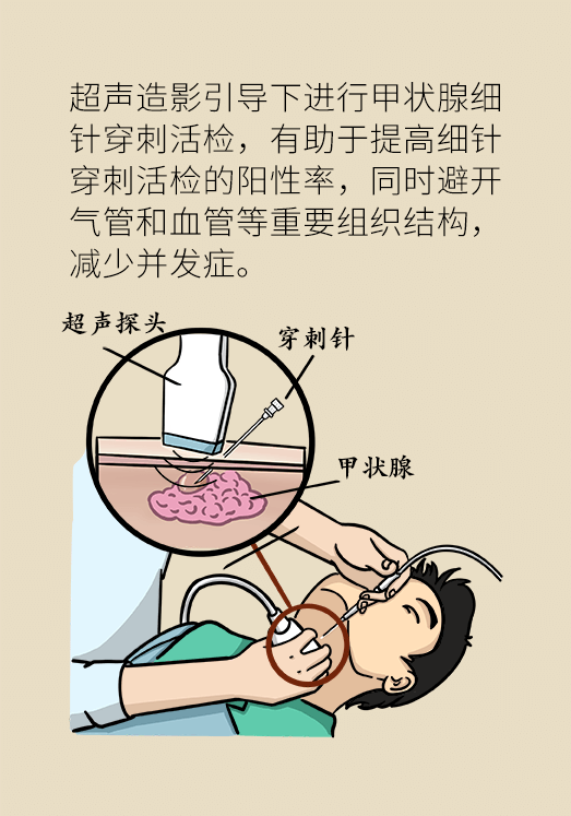 发现甲状腺结节该怎么办甲状腺结节会不会发生癌变