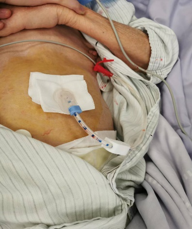 一步到"胃",胃造瘘术让患者不再"饭"难