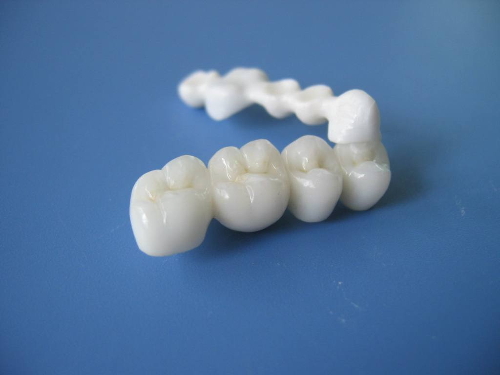 全瓷牙和烤瓷牙的区别究竟在哪?为什么医生都推荐做全瓷牙?