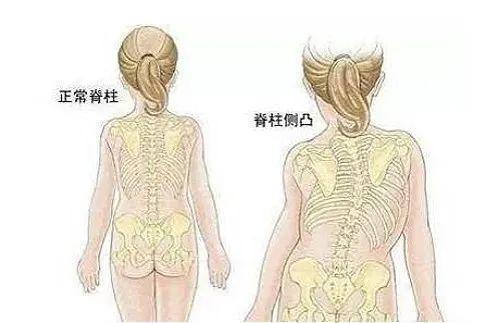 4个月宝宝被查出"脊柱变形",原来竟是因为这个,太吓人了