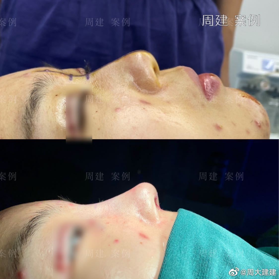 哑铃鼻基底,新术式不移位,郑州周建医生鼻整形专访