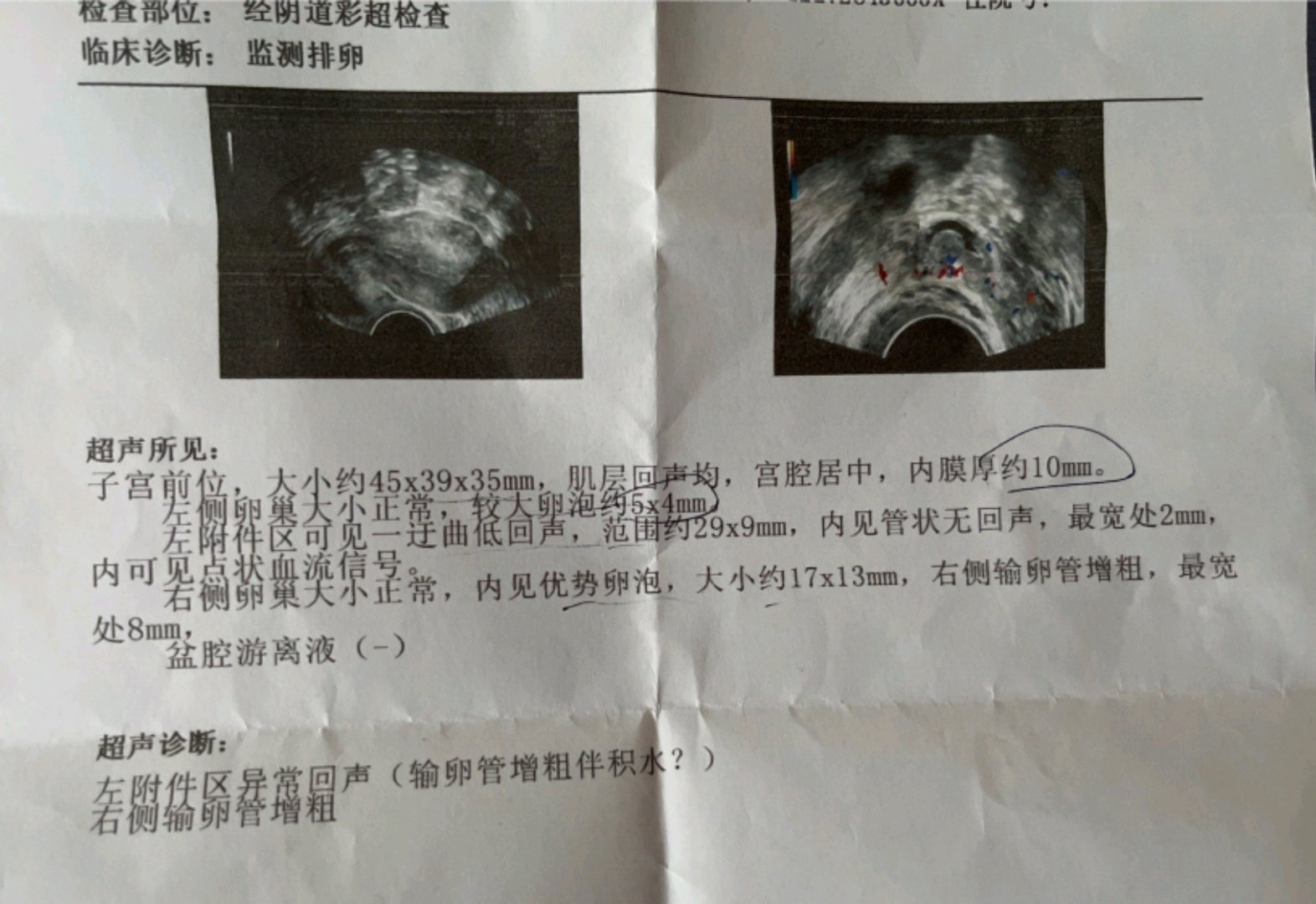 李女士腹痛,原来是输卵管积水导致