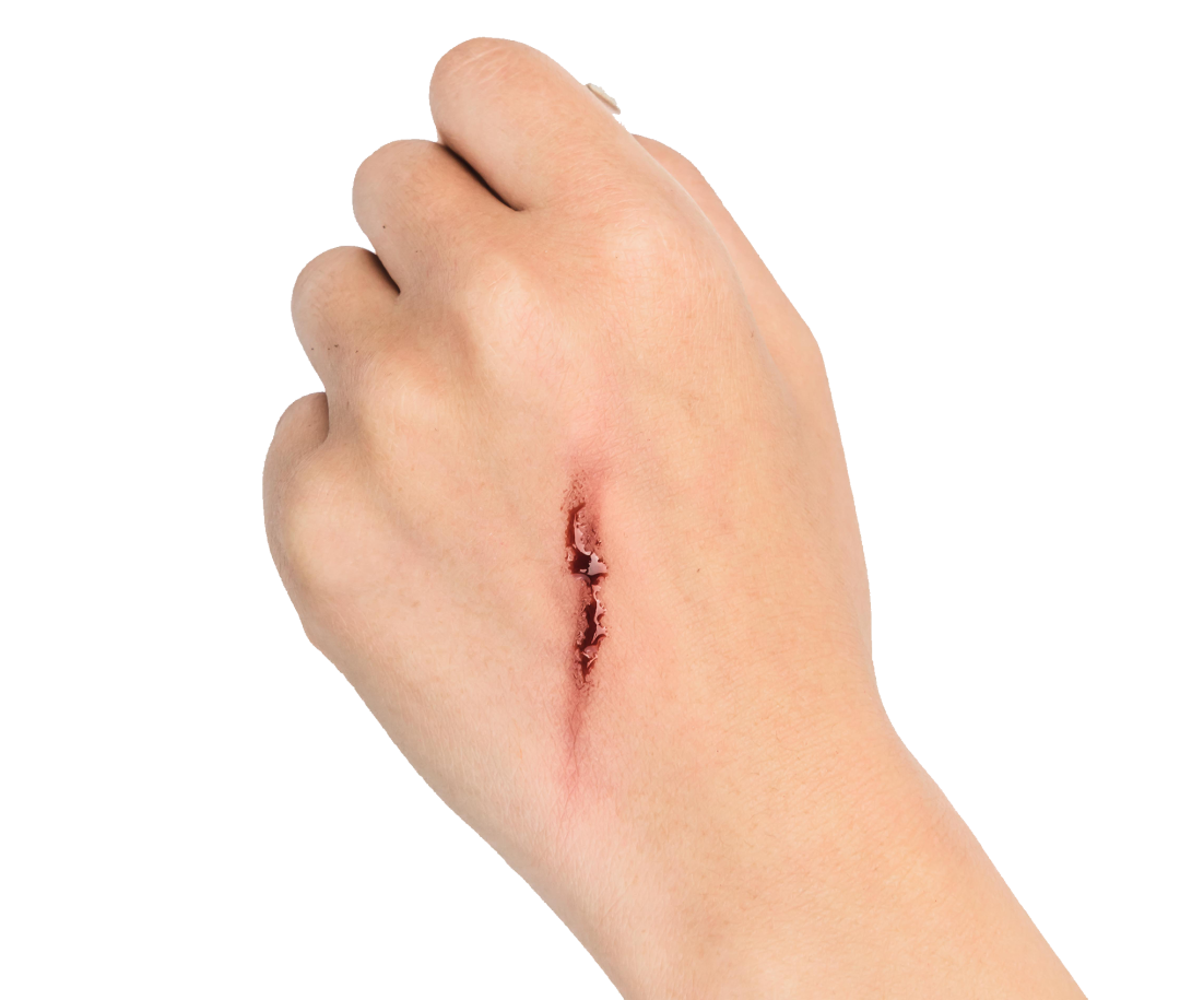 什么是破伤风?哪些伤口易引起破伤风?