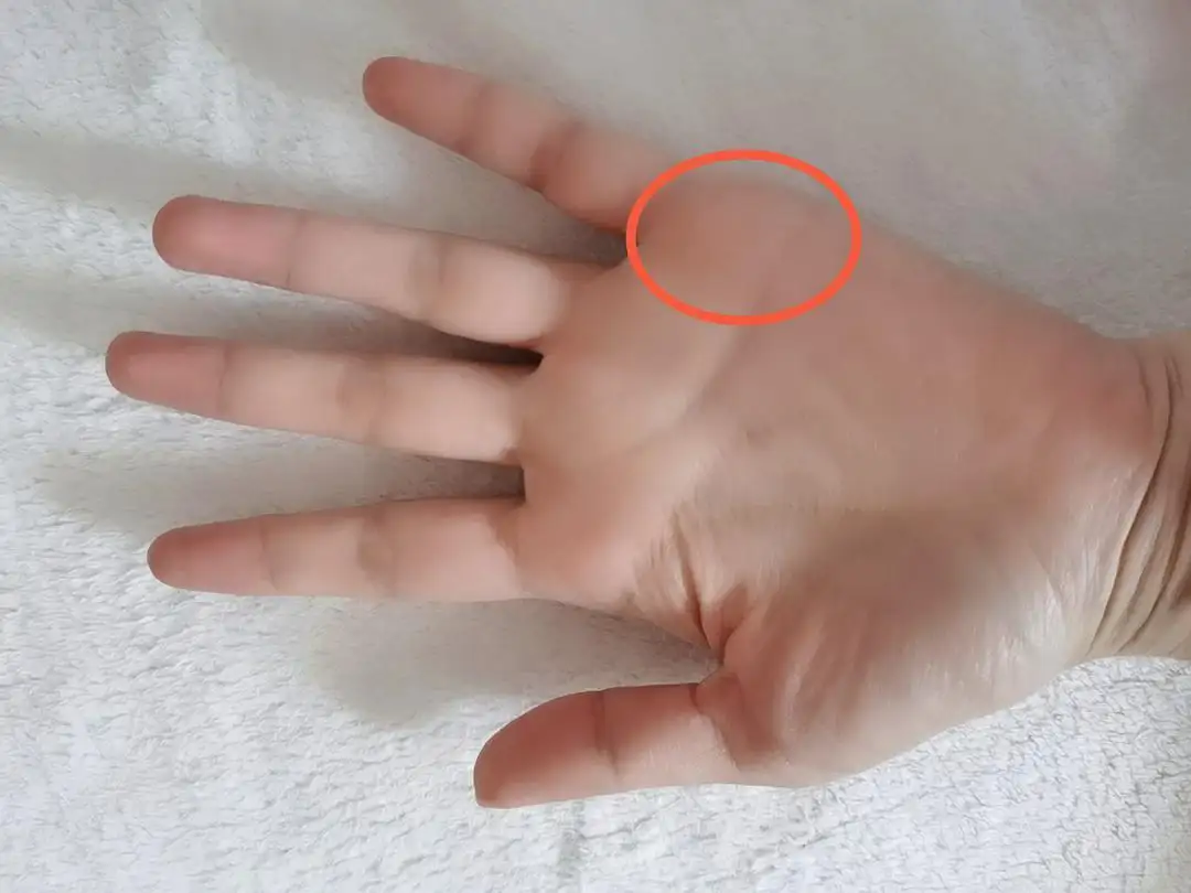 早上醒来,手指握不紧,双手发胀,这是怎么回事?