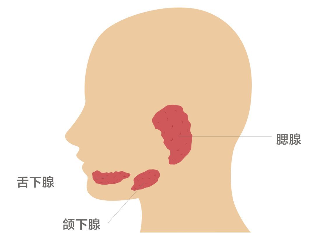 急性颌下腺炎由下颌腺导管狭窄或者阻塞引起,多见于成年人