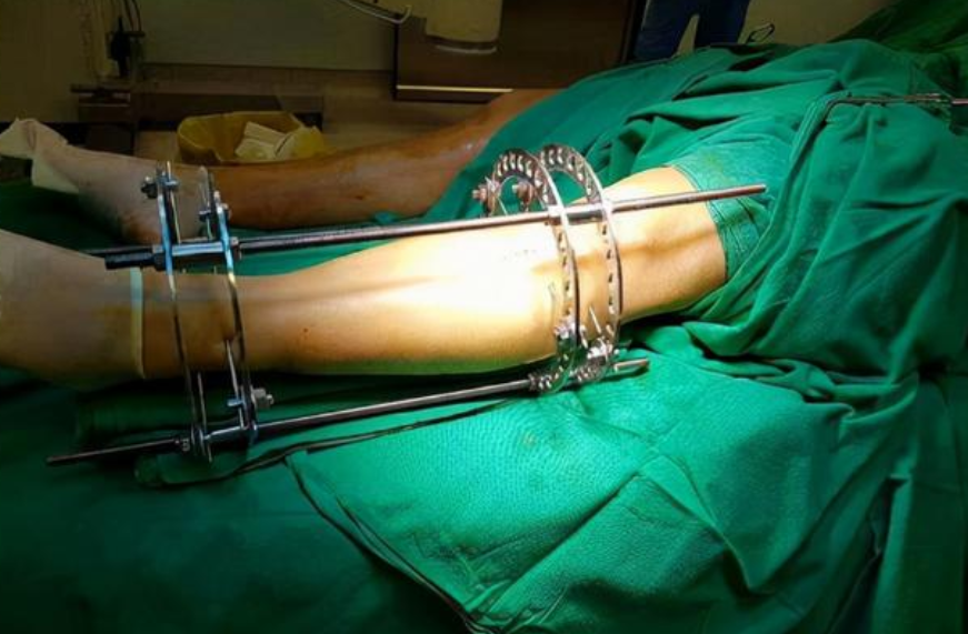 2014年,北京小伙花16万断骨,只为增高7厘米,如今与后遗症为伴