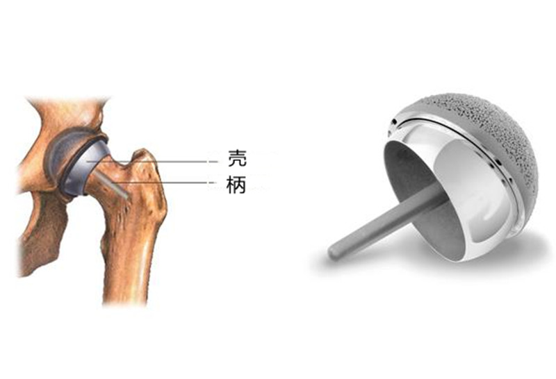 给大腿骨戴个"帽子",髋关节表面置换到底好吗?医生告诉你
