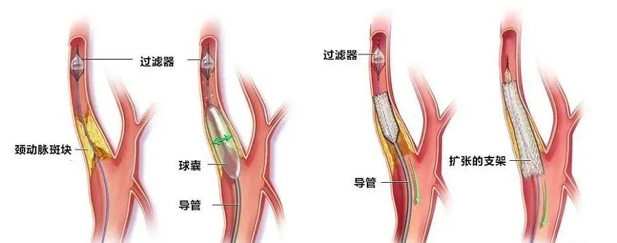 颈动脉的图片和示意图图片