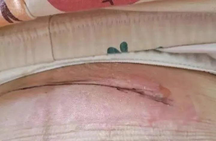 剖腹产疤痕增生严重?过来人支你三招,居家温和祛疤不留痕!