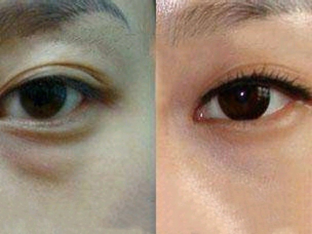 眼袋形成的原因是什么,眼袋能消除吗?