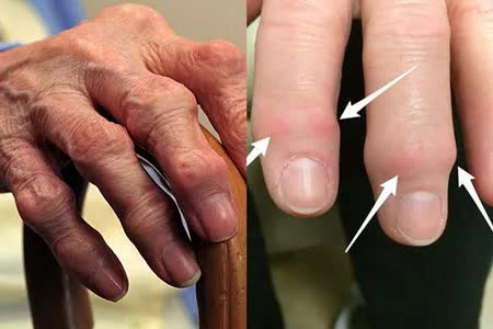 手指关节疼痛,肿大,是骨关节炎还是类风湿关节炎呢?