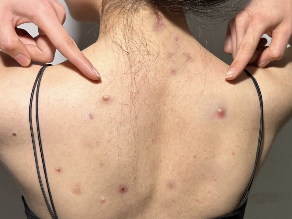 后背长痘真不是毛囊炎!螨虫过敏者自述祛痘经历!立马拥有牛奶背