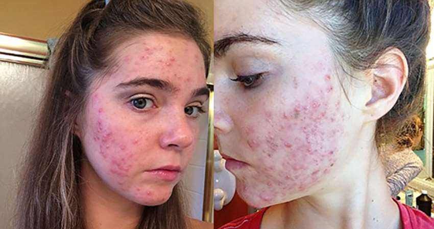 很多人不懂螨虫的危害?警惕孩子被螨虫盯上,快来学如何安全除螨