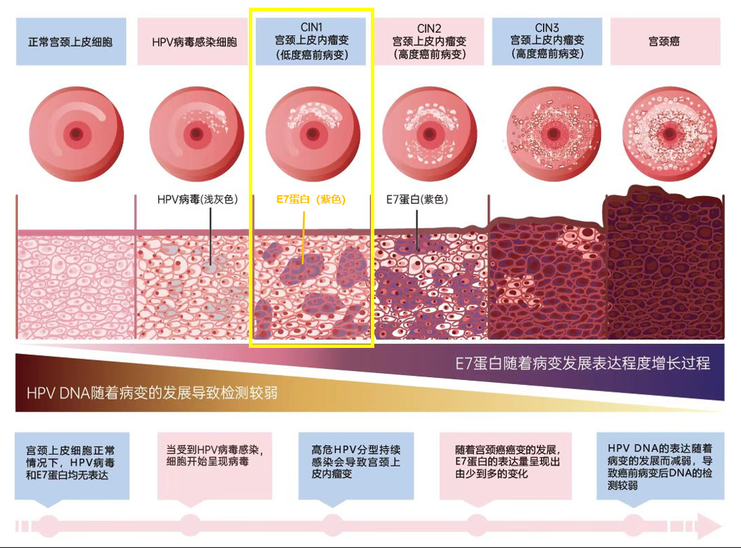 北京大学第一医院赵健:如果我们自己能够检查自己的宫颈有没有病