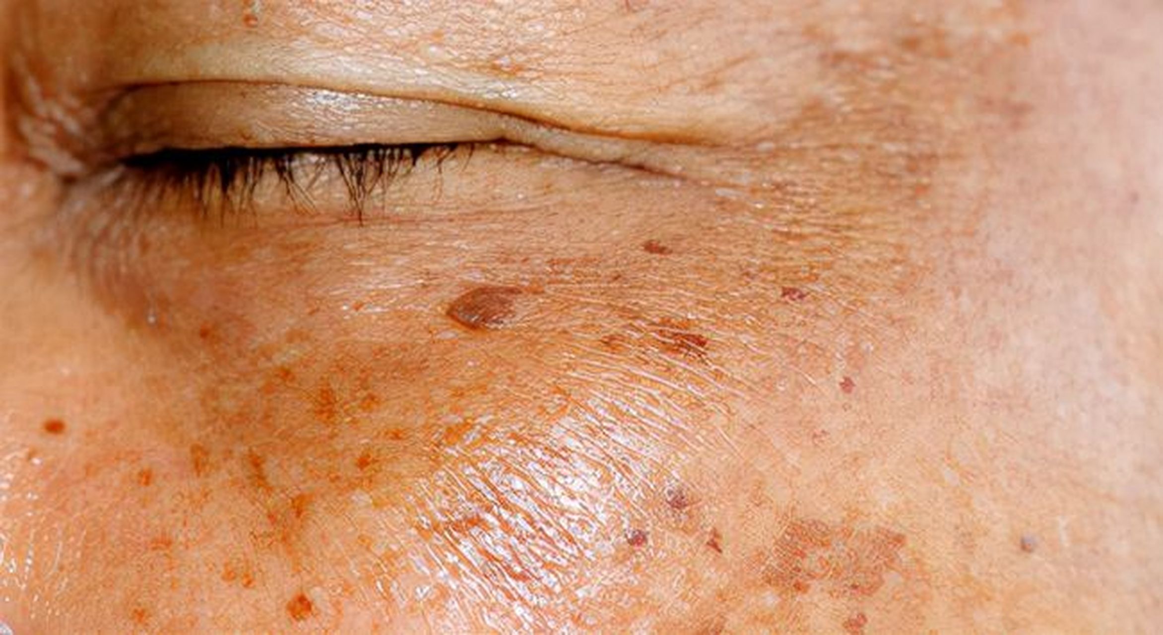 脸上色斑黑色素沉淀怎么去除 #医美科普挑战赛#   对于皮肤黑色素沉淀