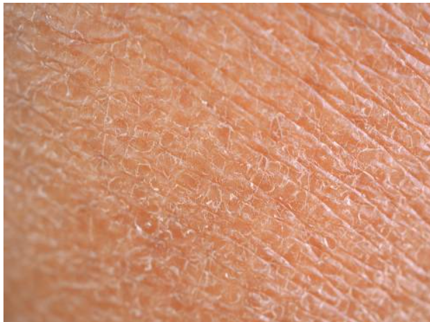 皮肤日晒损伤严重,严重影响着健康和美容,这样的问题如何解决?