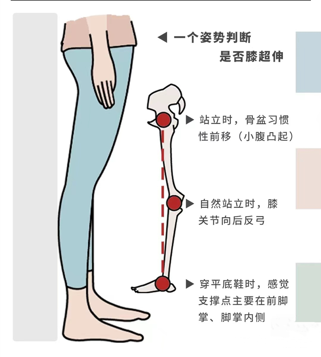 膝超伸怎么改善图片