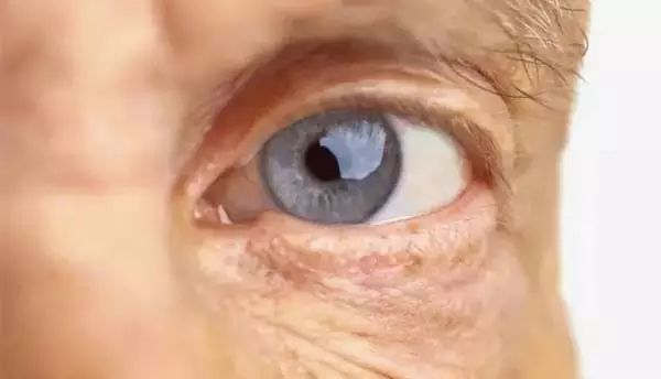 青光眼专家吴仁毅教授解答:上海青光眼早期症状哪些?